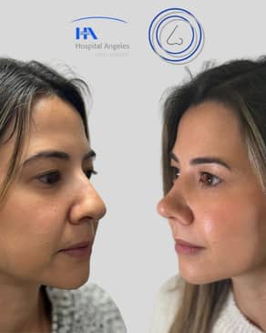 Slider image (3) Dr. Guillermo Guerra Gil de Leyva - Rhinoplasty Specialist